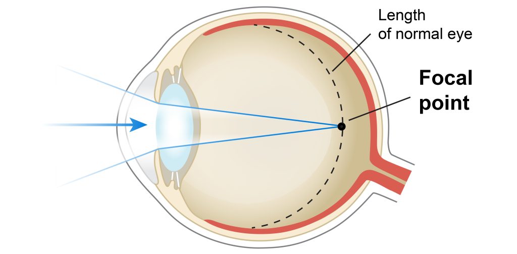 Diagram of human eye focusing light.